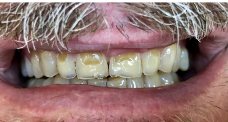 Sevrely discolored and damged teeth